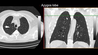 Essential normal variants the chest radiologist doesnt want you to know [upl. by Ettennaj]