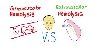 Extravascular Hemolysis [upl. by Rocco]