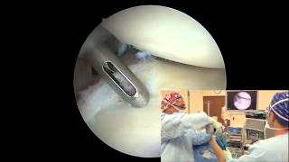 Arthroscopic Posterior Labral Repair  Randy S Schwartzberg MD [upl. by Trebeh]