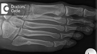 What should one do to speed up the recovery post surgery for Metatarsal Fracture  Dr Mohan M R [upl. by Doralyn]