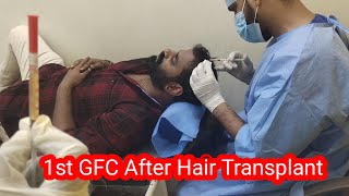 1st GFC After Hair Transplant in HSN Hair Transplant Clinic in BangaloreTamil Hair Transplant [upl. by Dara]