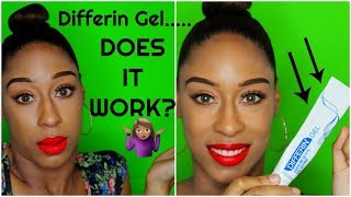 HOW TO USE DIFFERIN GEL DOES DIFFERIN GEL REALLY WORK 🤷🏾‍♀️ [upl. by Minor]