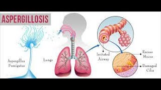 Aspergillosis  causes symptoms treatment  aspergillus fungal lung infection  aspergilloma [upl. by Ahsekel]