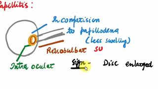 OPTIC NEURITIS  Ophthalmology  3 [upl. by Ttirrem719]