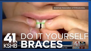 DIY Braces [upl. by Hairabez]