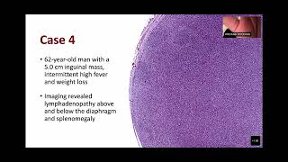 FOLLICULAR LYMPHOMA [upl. by Notsyrb103]