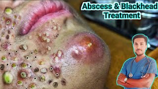 Abscess Treatment Causes Symptoms and Removalquot [upl. by Acinaj]