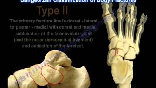 Navicular Fractures  Everything You Need To Know  Dr Nabil Ebraheim [upl. by Lussi]