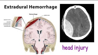 extradural hematoma  head trauma 1 headinjury [upl. by Sivart]