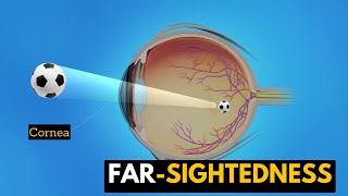 Farsightedness Causes Signs and Symptoms Diagnosis and Treatment [upl. by Lakym937]