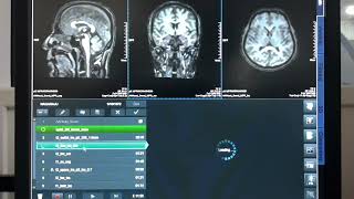 MRI BRAIN WITH FACIAL PALSY  PLANNING AND PROTOCOL  ITS RADIOLOGY [upl. by Ayin]