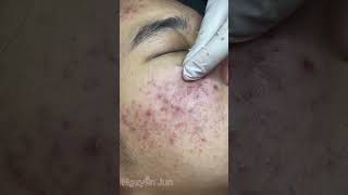 Acne skin care and treatment restore damaged skinđiềutrịmụn [upl. by Tish]