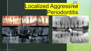 LOCALIZED AGGRESSIVE PERIODONTITIS [upl. by Notniuq673]