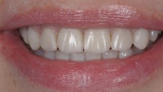 Композитные виниры Composite veneers Виниры до и после [upl. by Pyszka]