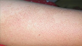 how to get rid of dots on legs after shaving [upl. by Tager]