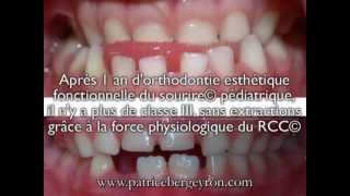 Mâchoire du bas en avant enfant de 3 ans  correction avec 1 an dOEFS© pédiatrique dont le RCC© [upl. by Drexler]