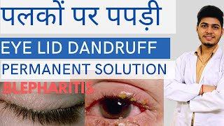 पलकों पर पपड़ी आना Permanent इलाज। Blepharitis treatment [upl. by Lora]