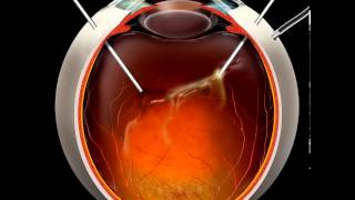 Vitrectomy animation [upl. by Assenav202]