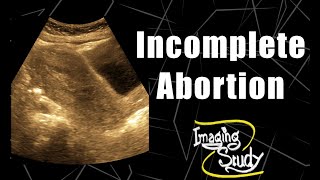 Incomplete Abortion  RPOC  Ultrasound  Case 134 [upl. by Ileray433]