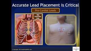 EKG Lead Placement [upl. by Johnsten]