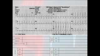 12 Lead Interpretation Part 62 EKG Changes and Lead Localization of Myocardial Infarctions [upl. by Anyat515]