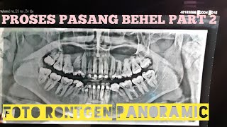 PROSES PASANG BEHEL GIGI PART 2FOTO RONTGEN GIGI PANORAMIC [upl. by Enna]