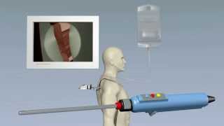 Shoulder Arthroscopy [upl. by Ayerf]