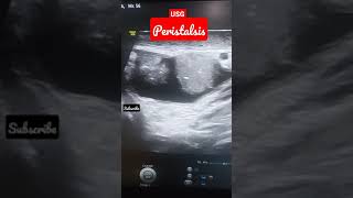 BOWEL LOOPS SHOWING PERISTALSIS IN ULTRASOUND🙂 [upl. by Alat970]