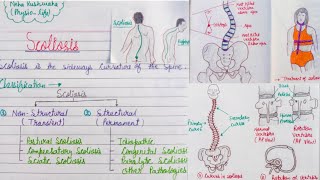 Scoliosis classification pathologydiagnosistreatment [upl. by Olaf]