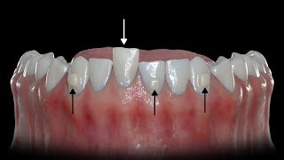 How Buttons Help Clear Aligners [upl. by Sivartal762]