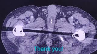 Malposition of Folley catheter  the importance to check   CT findings [upl. by Mylo]