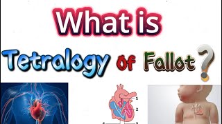 Tetralogy of fallot [upl. by Ratcliff]