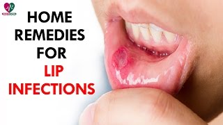 Home Remedies For Of Lip Infections  Health Sutra [upl. by Curson995]