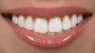 Difference Between Crowns and Veneers [upl. by Sylas193]