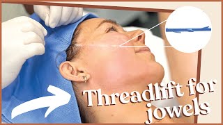 PDO THREAD FACELIFT TO FIX JOWL AND FACIAL ASYMMETRY [upl. by Bradford450]