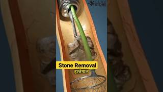 Kidney stone treatment  Renal stones  RIRS  Retrograde intrarenal surgery  shorts [upl. by Rossie]