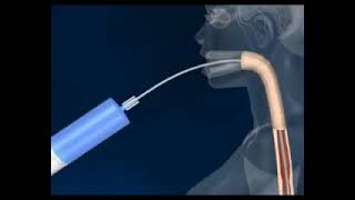 Endoscopic Gastric Balloon  How It Works [upl. by Rorry181]