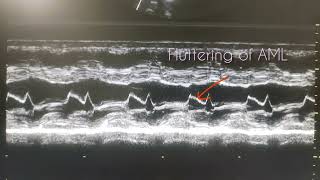 Mild AR can cause fluttering of AML [upl. by Eirojram]