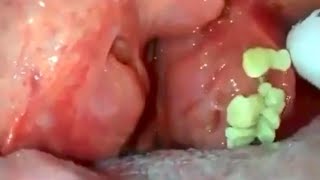 big tonsils stones removal tonsilolith removal big hidden tonsils stone removal [upl. by Claudette]