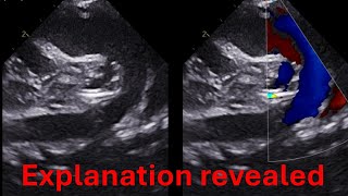 Truncus arteriosus  single ventricle and more  Explanation of case 1 [upl. by Solracnauj]