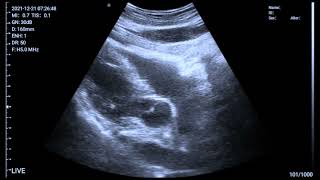 Heart Ultrasound Subxiphoid View aortic and mitral valve slow motion [upl. by Haldane]