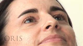 Botox training  Crows Feet  Oris Medical [upl. by Chao]