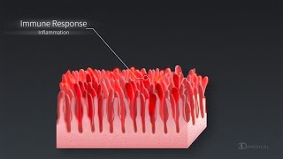 What is Celiac Disease  World Digestive Health Day [upl. by Leinoto]