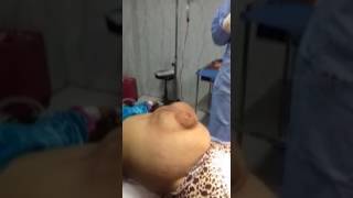 Huge Incisional Hernia in ascitic Patient doctor Gamal Osman Zagazig Abohamade [upl. by Urbana]