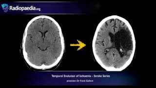 Stroke Evolution from acute to chronic infarction  radiology video tutorial CT MRI [upl. by Einej]