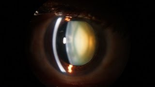 Slit Lamp examination of the anterior segment of the eye [upl. by Garwood]