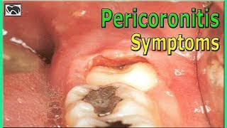 What is Pericoronitis Causes and Symptoms  Wisdom Teeth [upl. by Montfort496]