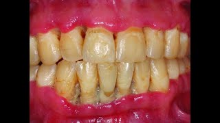 Trench Mouth Symptoms Causes and Treatment Options Explained [upl. by Greerson]