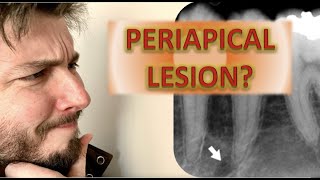 How to Identify a Periapical Radiolucency Abscess Cyst Granuloma Root canal infection x rays [upl. by Yemarej897]