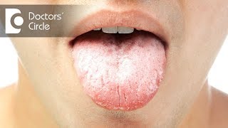 Causes and symptoms of oral thrush  Dr Jayaprakash Ittigi [upl. by Perce441]